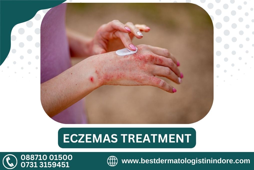 Best Dermatologist for Eczema Treatment Near Goyal Nagar in IndoreBest Dermatologist for Eczema Treatment Near Goyal Nagar in Indore